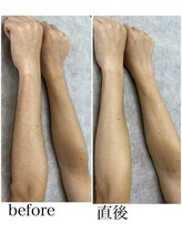ゼロミリメートル(0mm)/【脱毛】ビフォーアフター