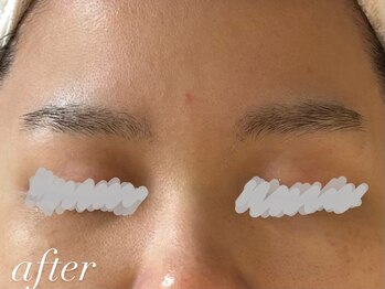 フォー(For...)/美白ケア/毛穴黒ずみケア◎