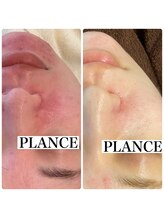 プランス 恵比寿店(PLANCE)/肌質改善/恵比寿/エステ