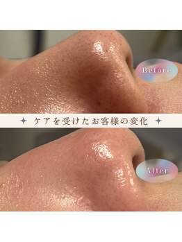 アットウィル 志木店(at will)/毛穴洗浄BeforeAfter