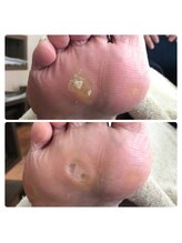 厚木 海老名 巻き爪矯正センター/事例【ドイツ式フットケア】