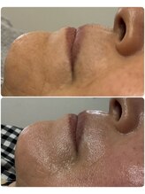 エミニー(Eminy)/フェイシャルワックス+プラズマ