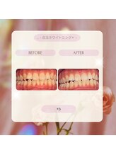 プラスビー 2号店(+b)/ホワイトニングビフォーアフター