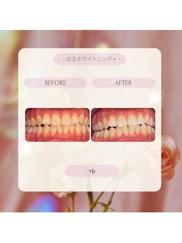 プラスビー 2号店(+b)/ホワイトニングビフォーアフター