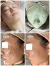 《毛穴＋角質＋ニキビケア》ゆらぎ肌荒れに◎ゴワつき卒業♪つるすべ肌に80分
