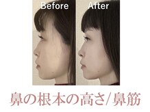 ラプリシュシュ 岡山店(Raplit)/ 隆鼻＋輪郭矯正40分10回