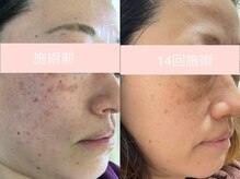 シミケア専門店 SAKURA 平塚店/平塚シミケア/伊勢店シミケア