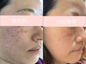 シミケア専門店 SAKURA 平塚店/平塚シミケア/伊勢店シミケア