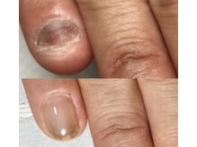 イズム(Izm)/上before/下after 約3ヶ月時点