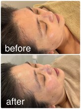 ユララ(YURARA)/アクアピュア×美容鍼でトーンUP