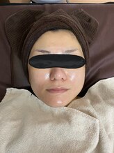 エクラルム(Eclaleum)/After　PHA水光ピーリング