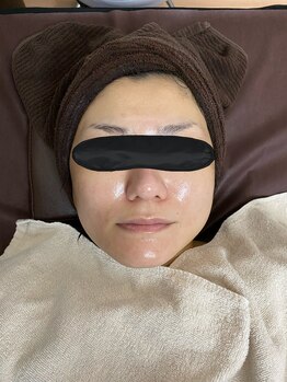 エクラルム(Eclaleum)/After　PHA水光ピーリング