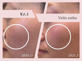 ヘアーアンドエステティック ヴェリス(hair&esthetic Velis)/当店エステ改善症例　No.1