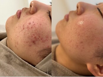 ピブ(PIBU)/思春期ニキビ/ハーブピーリング