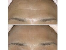 リュミエール(umiere)/しわ、ハリ、たるみケア