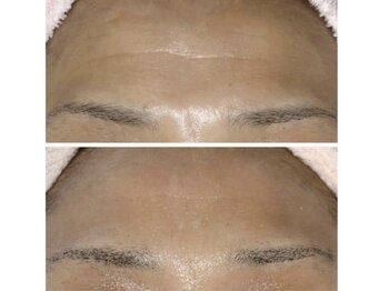 リュミエール(umiere)/しわ、ハリ、たるみケア