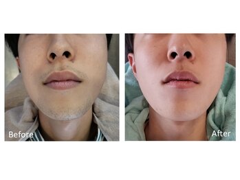 リッカ 学芸大学(RIKKA)/ひげ脱毛