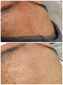 マロン 能町(Marron)/お悩み　ニキビ