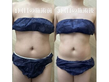 介正鍼灸整骨院 整体院 エフコープ大野城店/痩身エステ＊ラジオ波／キャビ