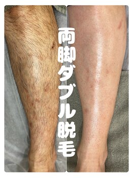ジョエルワックス 沖縄糸満店(JOELLE WAX)/短パンでも大丈夫！両脚脱毛