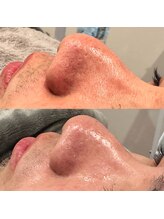 アール(ar.)/ハイドラ毛穴洗浄フェイシャル