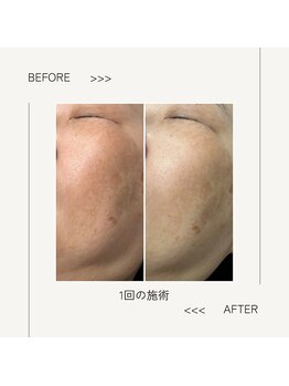 ワイドット(Y.)/肌色の変化