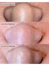 毛穴美/肌は変わる！変えられる！！