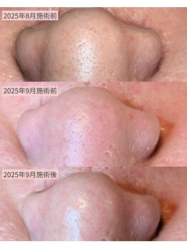 毛穴美/肌は変わる！変えられる！！