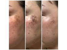 ギンザ111 プライベートルーム(Ginza 111 Private room)/光フェイシャル