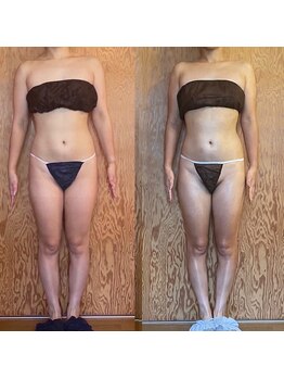 チェイル(JEIL)/痩身コルギ