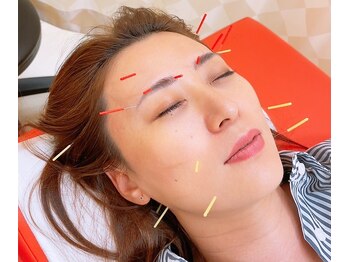 ほねつぎ 平成けやき通り鍼灸接骨院/美容メニュー 人気NO.1 美容鍼