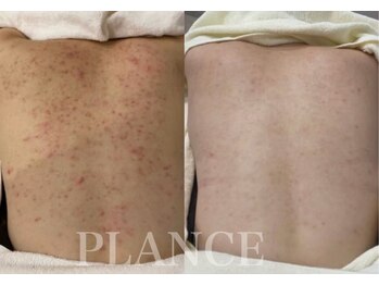 プランス 恵比寿店(PLANCE)/背中/ブライダルエステ/恵比寿