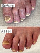 リゼラアンドコー 川越南古谷店/高齢者の足爪カット