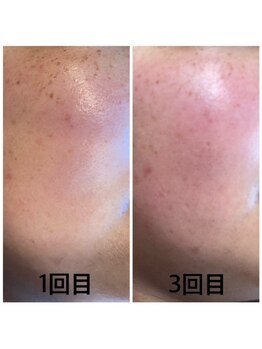 ヘアデザインアンドエステティック リコ(hair design&esthetic rico)/シミケアプラズマ