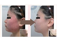 ガネェーシャ(Ganesha)/水光ピーリングビフォアフ