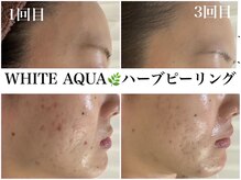 ホワイトアクア 福岡天神店(WHITE AQUA)/ハーブピーリング1回～3回