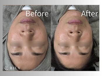 リリー(RILY)/【プラズマビフォーアフター】