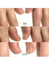 リンク(LINK)/お爪の変化