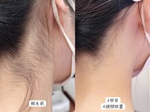 セルフメイド 東大阪店(SELFMADE)/うなじ脱毛♪BeforeAfter