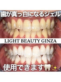 ライトビューティー 銀座店(LightBeauty)/東銀座 ホワイトニング症例写真