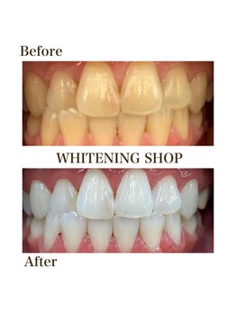 ホワイトニングショップ 津田沼店/before&after美白ホワイトニング