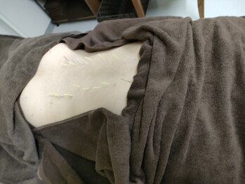 ハリキュウナチュラ(harikyuナチュラ)/腰への施術/腰痛/足のだるさ