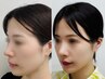 頭皮リフト【顔のたるみ改善】再生美容¥44,000→33000