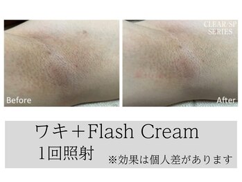 セラス(CERAS)/プラズマ脱毛