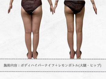 エメ 名古屋栄店(aimer)/レモンボトル<痩身・脂肪分解>