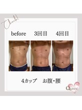 クイーン(QUEEN)/脂肪冷却　4カップ