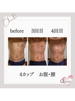 クイーン(QUEEN)/脂肪冷却 4カップ