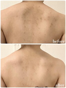 リリィブラン(Lily branc)/Body美白ピーリング/シミケア