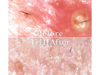 ミニョスキンラボ/韓国式ハーブピーリング4回