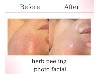 サロンツキ(salon tuki)/ハーブピーリング/光フォト症例